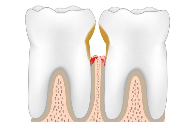 Протезирование зубов при пародонтозе и пародонтите