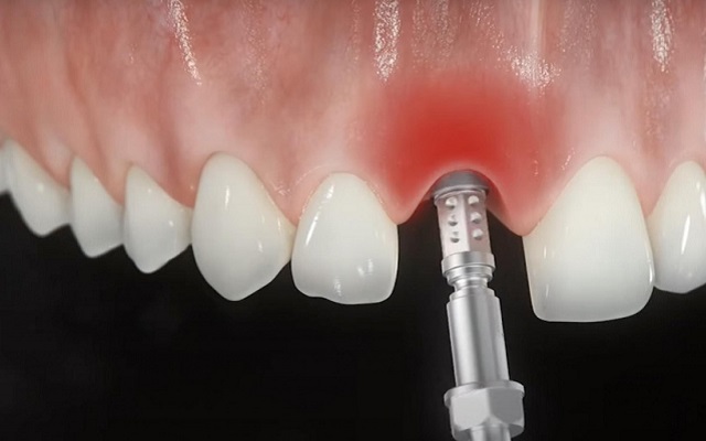 Есть ли вред от зубных имплантов