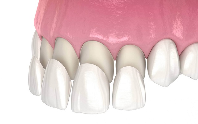 Реставрация зубов - варианты восстановления